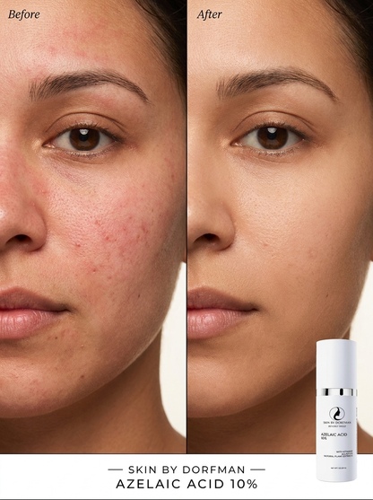 Azelaic Acid 10%